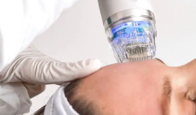 Whats the benefits of RF microneedling treatment?