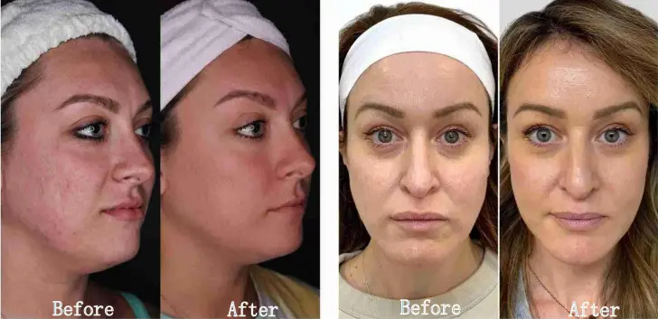 M8 Microneedle Rf Machine